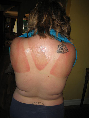 funny-sunburn-12