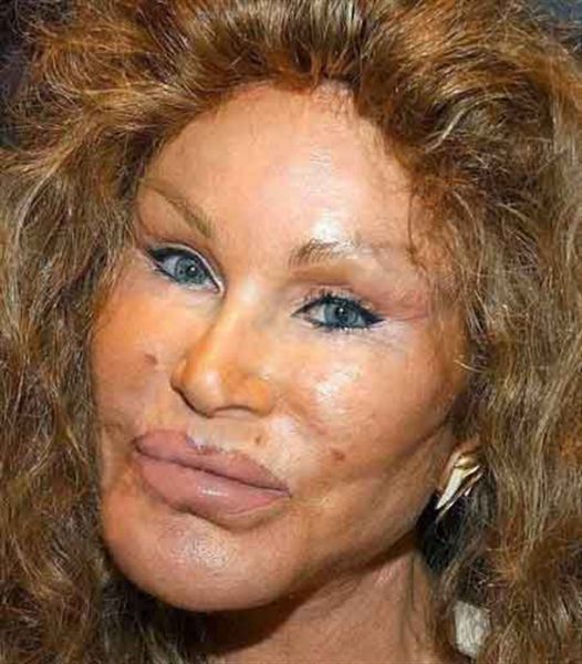 when_plastic_surgery_goes_really_wrong_640_11