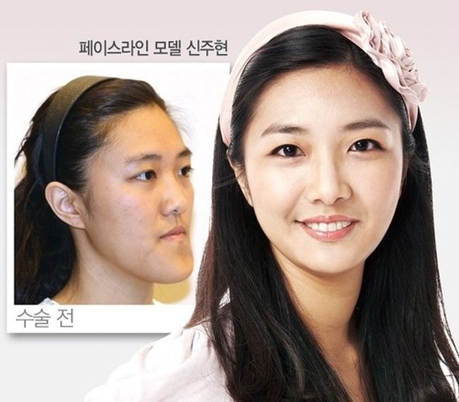 crazy_before_and_after_photos_of_korean_plastic_26