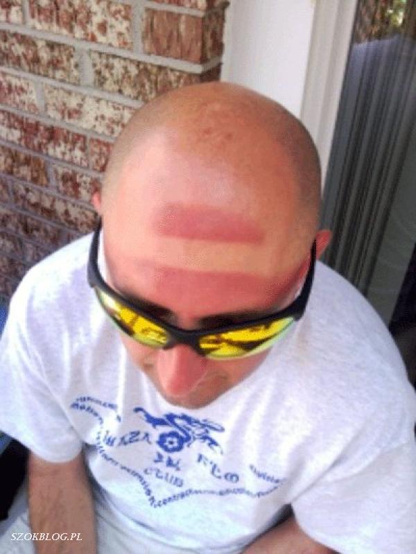 funny-sunburn-13