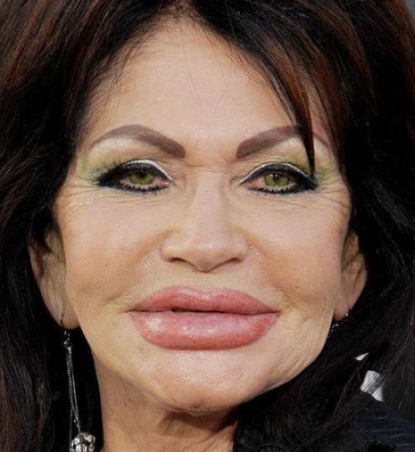 the_horrors_of_terrible_plastic_surgery_13