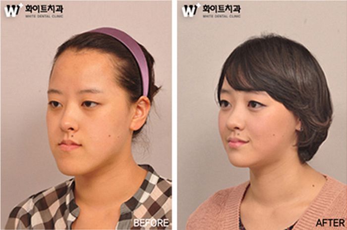 crazy_before_and_after_photos_of_korean_plastic_13