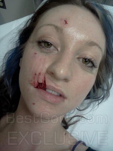 girl-bit-by-dog-in-face-best-gore-exclusive-05