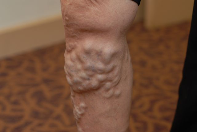 varicose-veins-03