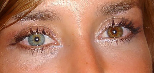 complete-heterochromia