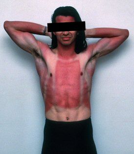 funny-sunburn-1