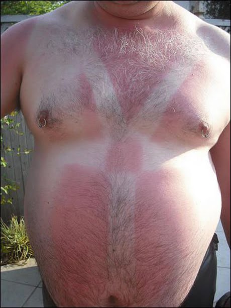 funny-sunburn-4