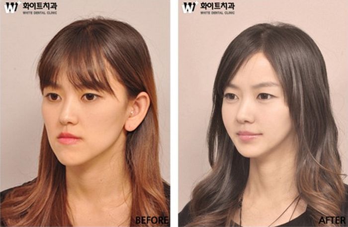 crazy_before_and_after_photos_of_korean_plastic_11