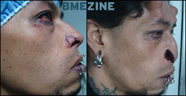 emilio-nose-reconstruction-1