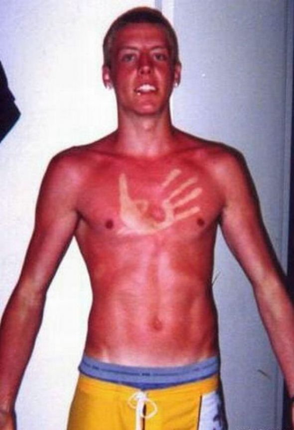 funny-sunburn-37