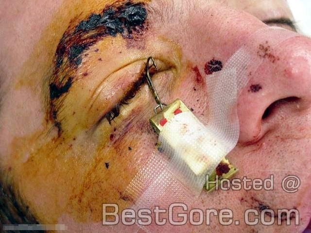 surgical-removal-fishhook-eye-03