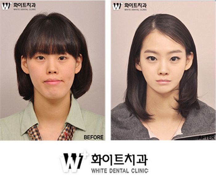 crazy_before_and_after_photos_of_korean_plastic_05